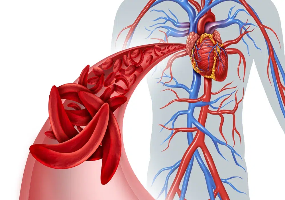 کم خونی یا آنمی؛ انواع، علائم و راه‌حل‌های درمان بیماری کم خونی