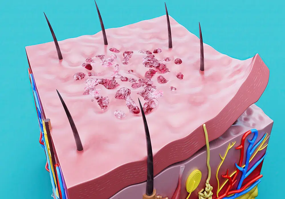 سیستمیک اسکلروز: شناخت علائم و روش‌های درمان موثر