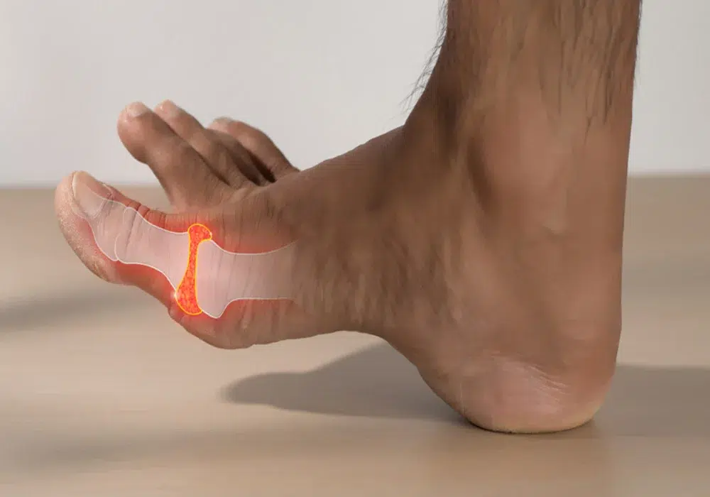 نقرس: علت، علائم و روش‌های درمان سریع