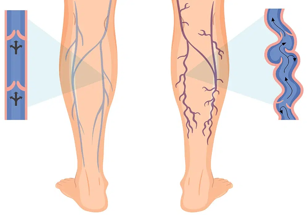 همه چیز درباره واریس؛ علائم، دلایل و روش‌های درمان آن