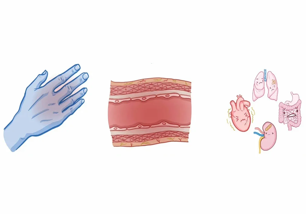 روش‌های درمان سیستمیک اسکلروز