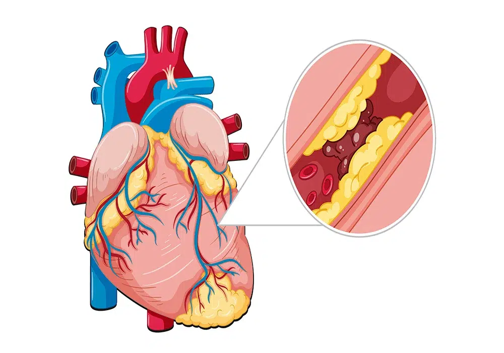 بیماری‌های دریچه‌ای قلب: علل، تشخیص و درمان