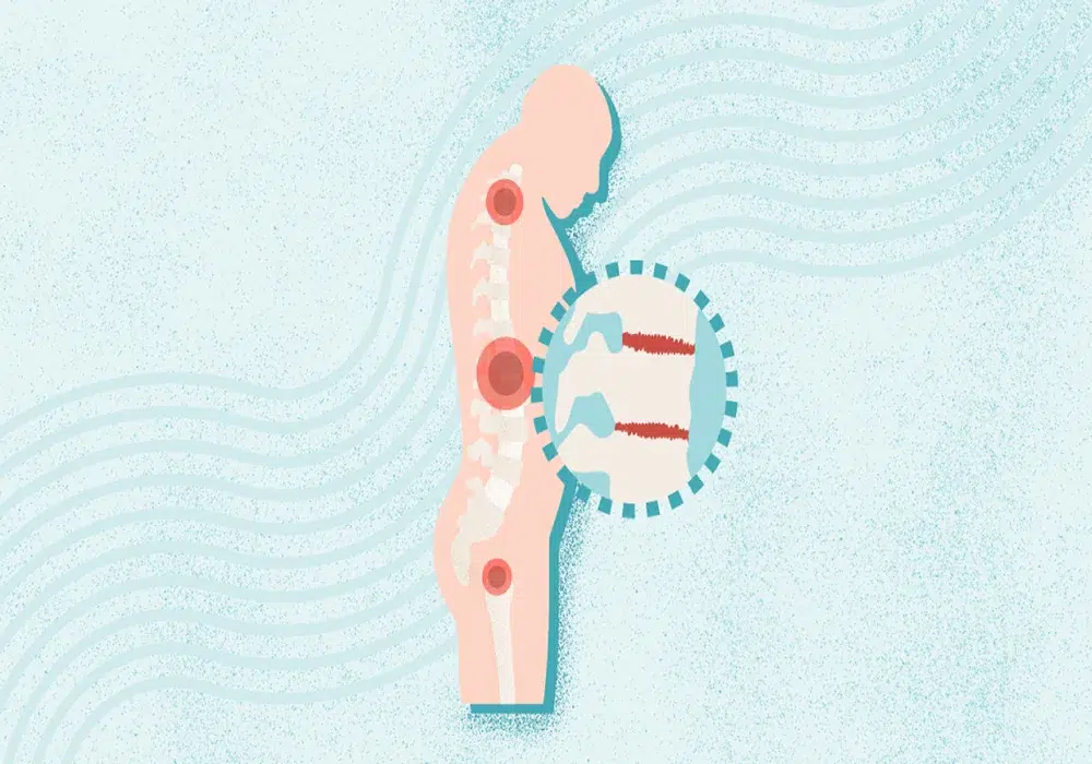 تشخیص و درمان اسپوندیلیت آنکیلوزان: مراقبت‌های ضروری برای مفاصل