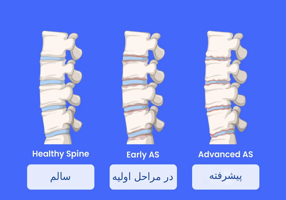 اسپوندیلیت آنکیلوزان چیست؟