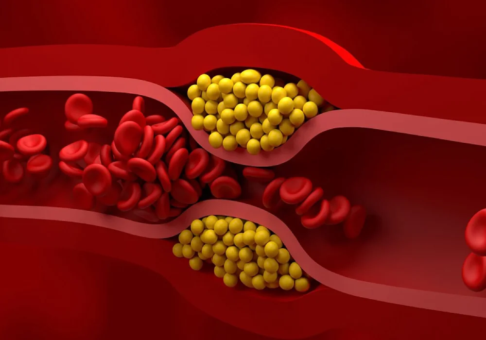 کلسترول بالا و تاثیر آن بر سلامت قلب