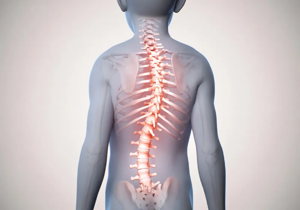 اسکولیوز در کودکان