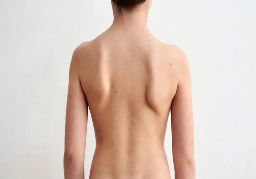 انواع اسکولیوز کودکان