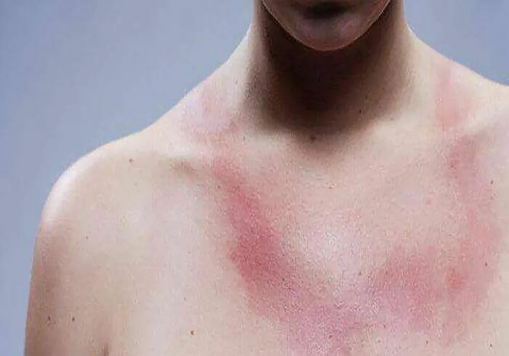 درمان بیماری بهجت