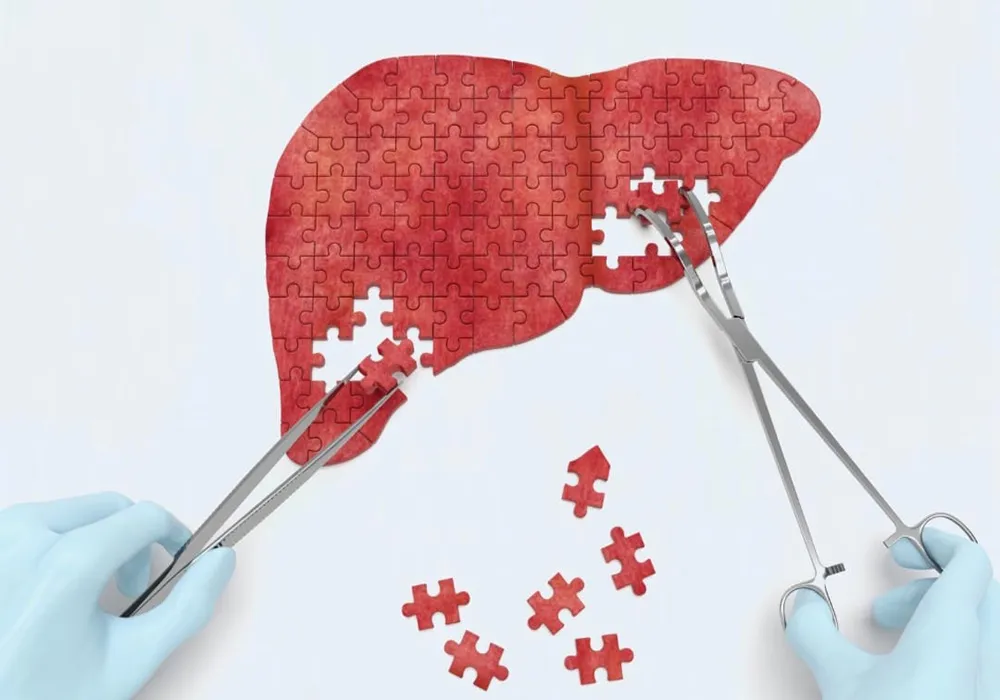 از کجا بفهمیم کبد چرب داریم؟ علائم کبد چرب گرید ۱، ۲ و ۳ به زبان ساده