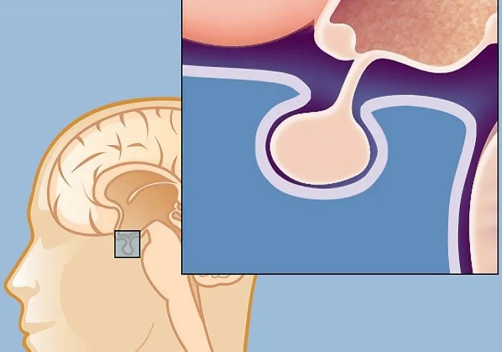 بیماری پرولاکتینوما