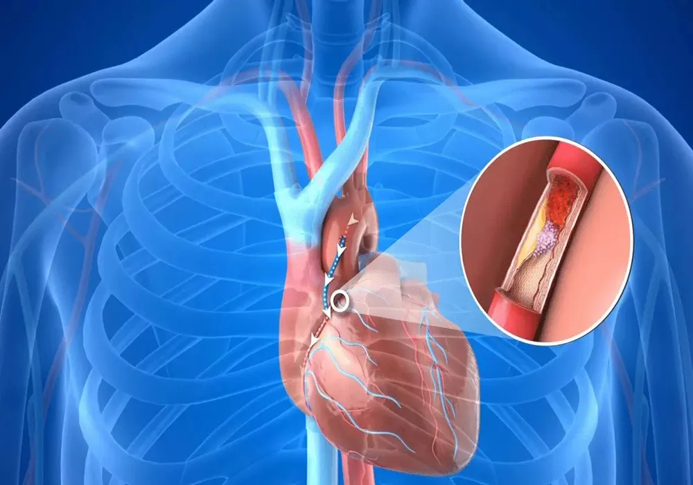 عمل بای‌پس قلب چیست و چگونه انجام می‌شود؟ مراقبت‌های قبل و بعد از عمل