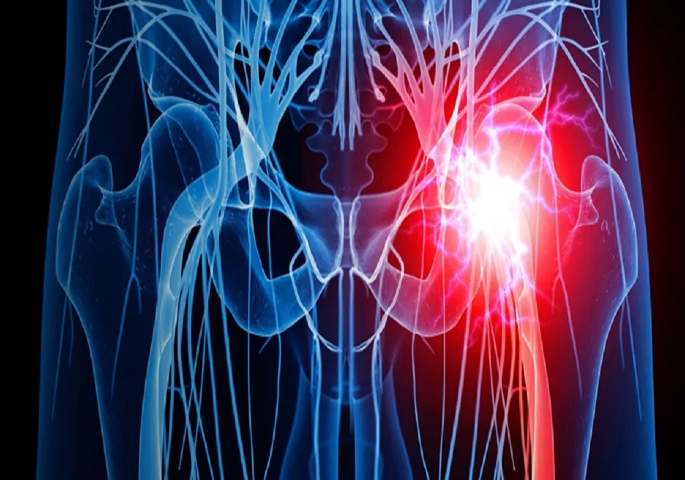 سیاتیک چیست؟ علائم گرفتگی و پارگی سیاتیک، بهترین روش درمان سیاتیک